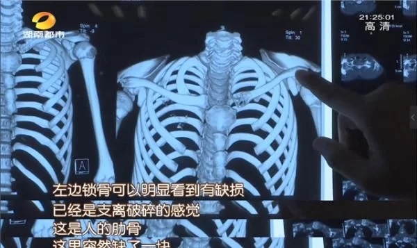 哮喘-慢阻肺-咳嗽-咳喘-支气管炎-肺功能检测仪-呼吸训练器