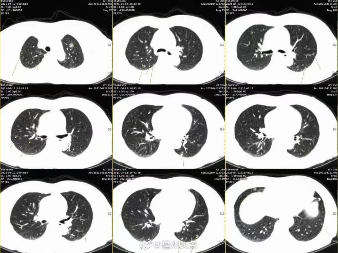 肺结节-磨玻璃结节-肺癌影像学筛查-肺癌-慢阻肺-肺结核-弥漫性肺纤维化-恶性肿瘤-高危职业-油炸-烹饪-吸烟-二手烟-局限性肺纤维化-肺部炎症-肺康复-呼吸训练器-肺功能检测仪-肺部CT-肺淤血